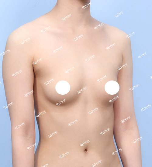 UNE 豊胸手術 術前 痩せ 30代 45度 症例 #30