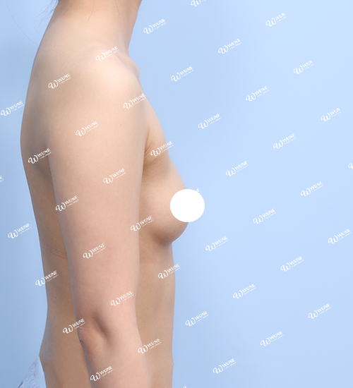 UNE 豊胸手術 術前 痩せ 30代 側面 症例 #30