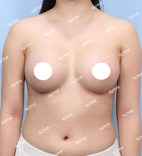 UNE 豊胸手術 術後 3ヶ月 モティバ 320cc ぽっちゃり 20代 正面 症例 #38