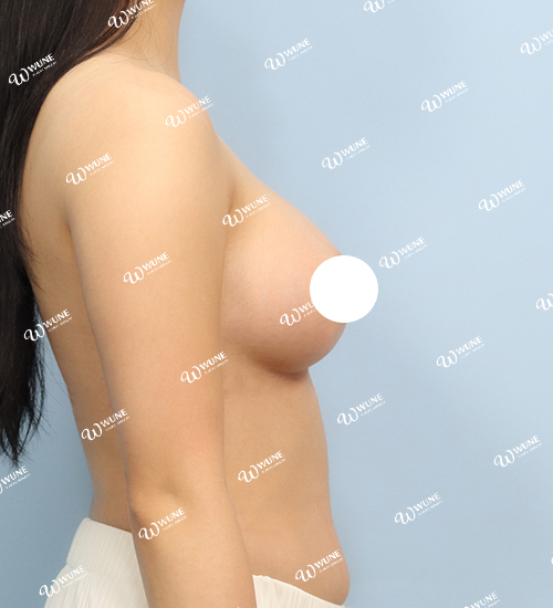 UNE 豊胸手術 術後 3ヶ月 モティバ 320cc ぽっちゃり 20代 側面 症例 #38
