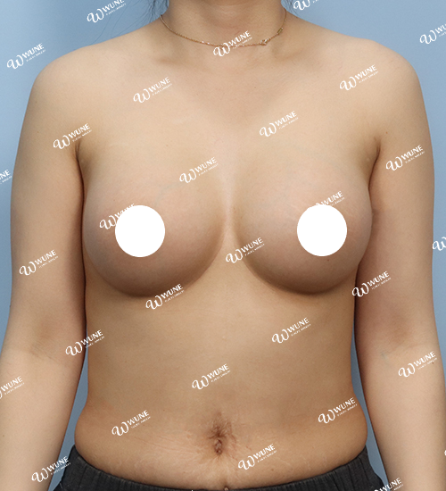 볼륨 부족을 교정한 가슴확대술 후 3개월 정면 사진 멘토 엑스트라 케이스 19