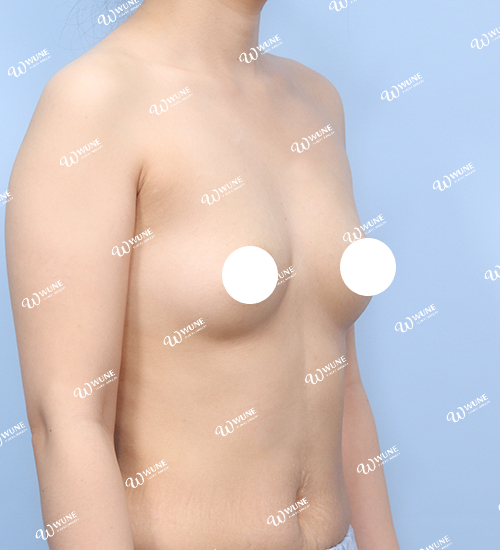 볼륨 부족을 교정한 가슴확대술 전 45도 사진 멘토 엑스트라 케이스 19