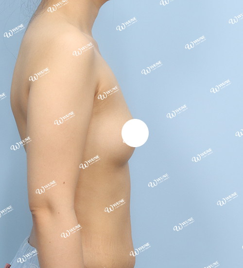 볼륨 부족을 교정한 가슴확대술 전 측면 사진 멘토 엑스트라 케이스 19