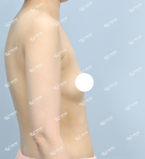 UNE 豊胸手術 術前 痩せ 20代 側面 症例 #50