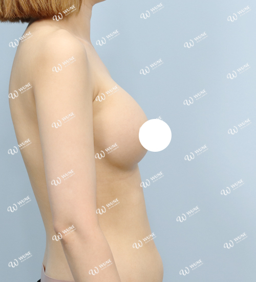 UNE 豊胸手術 術後 4ヶ月 モティバ 340cc 痩せ 20代 側面 症例 #50