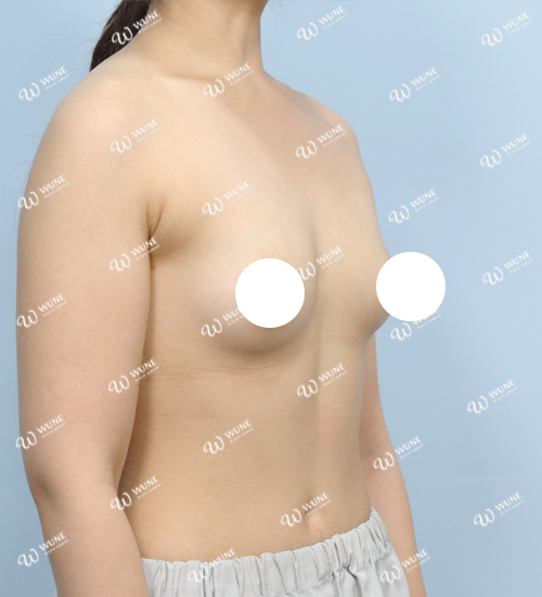 UNE 豊胸手術 術前 普通 20代 45度 症例 #51