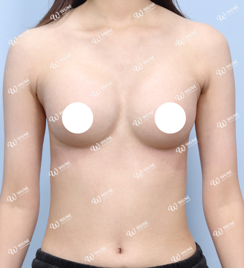 볼륨 부족을 교정한 가슴확대술 후 1개월 정면 사진 세빈 케이스 34