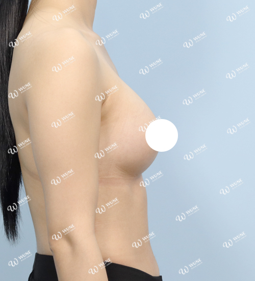 韩国隆胸前后对比 | 首尔江南 UNE 整形外科 | 隆胸手术 | 术后 3 个月 · 侧面 · 体积不足 · 中等体型 · 30多岁 · Mentor Xtra · 腋下切口 · 案例 #37