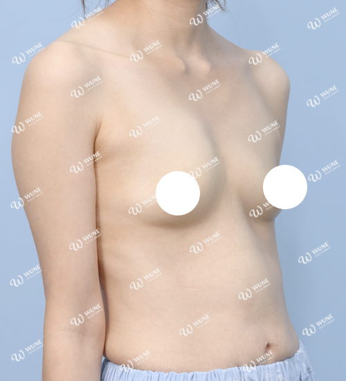 UNE 豊胸手術 術前 普通 30代 45度 症例 #59