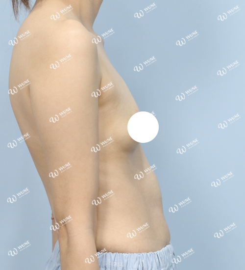 UNE 豊胸手術 術前 普通 30代 側面 症例 #59