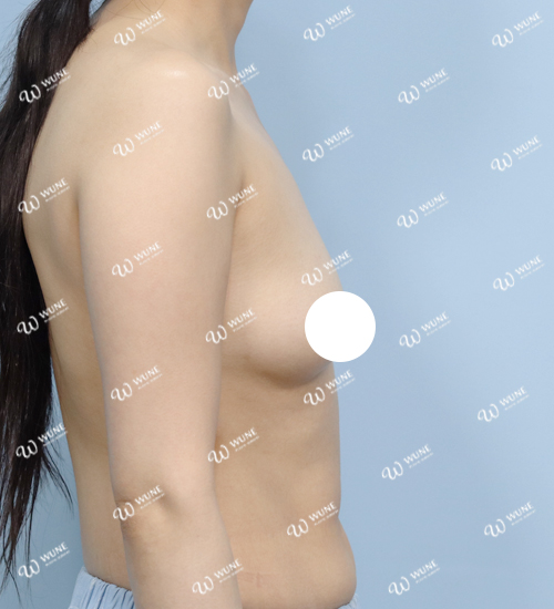 UNE 豊胸手術 術前 ぽっちゃり 30代 側面 症例 #61