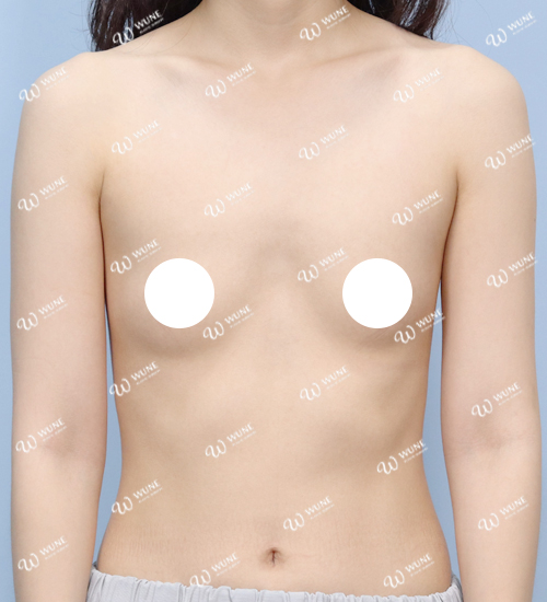 볼륨 부족을 교정한 가슴확대술 전 정면 사진 모티바