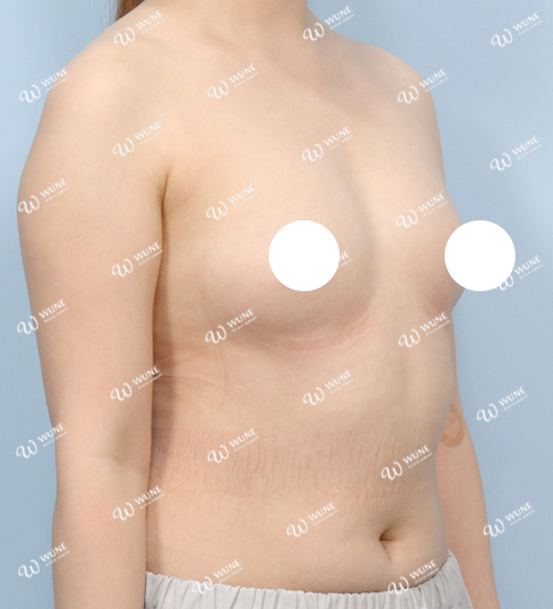 UNE 豊胸手術 術前 ぽっちゃり 30代 45度 症例 #68