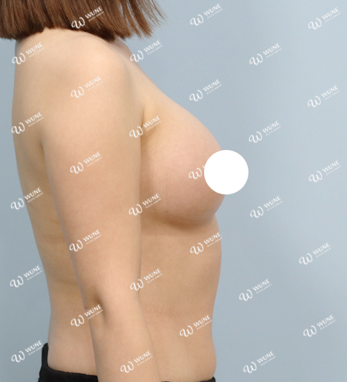 UNE 豊胸手術 術後 3ヶ月 モティバ 360cc ぽっちゃり 30代 側面 症例 #68