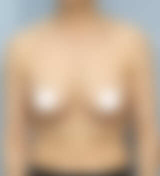 UNE Plastic Surgery - เสริมหน้าอก | After 5 mo · ด้านหน้า · ปริมาตรไม่เพียงพอ · ปานกลาง body · 50s+ · Mentor Boost · ใต้ราวนม incision · Case #62