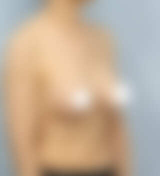 UNE Plastic Surgery - เสริมหน้าอก | After 5 mo · 45° · ปริมาตรไม่เพียงพอ · ปานกลาง body · 50s+ · Mentor Boost · ใต้ราวนม incision · Case #62