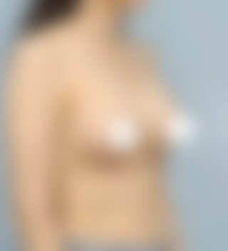 볼륨 부족을 교정한 가슴확대술 후 3개월 45도 사진 모티바 케이스 63