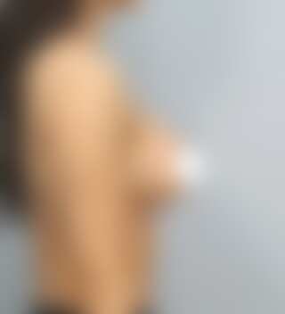 UNE バスト修正 術後 2ヶ月 モティバ 300cc 痩せ 30代 側面 症例 #91