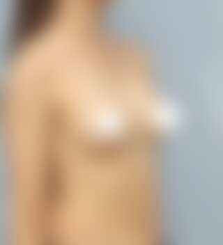 볼륨 부족을 교정한 가슴확대술 후 6개월 45도 사진 모티바 케이스 70