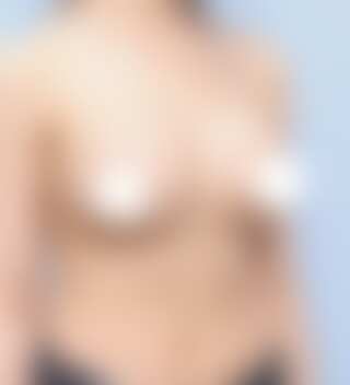 볼륨 부족과 심한 새가슴을 교정한 가슴확대술 후 6개월 45도 사진 모티바 케이스 71
