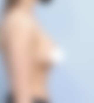볼륨 부족과 심한 새가슴을 교정한 가슴확대술 후 6개월 측면 사진 모티바 케이스 71