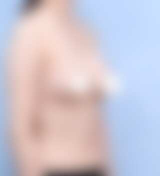 UNE 豊胸手術 術後 3ヶ月 モティバ 360cc ぽっちゃり 30代 45度 症例 #15