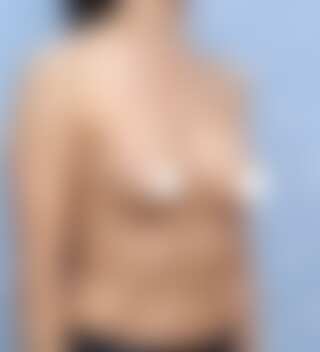 UNE 豊胸手術 術後 12ヶ月 モティバ 340cc 痩せ 40代 45度 症例 #19