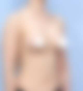 UNE 豊胸手術 術後 3ヶ月 モティバ 320cc 痩せ 30代 45度 症例 #29