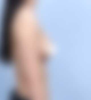 UNE 豊胸手術 術後 1ヶ月 モティバ 245cc 痩せ 30代 側面 症例 #30