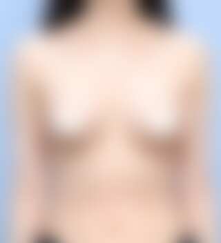 UNE 豊胸手術 術後 7ヶ月 モティバ 285cc 普通 30代 正面 症例 #32