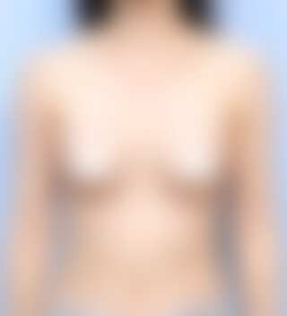 UNE 豊胸手術 術後 1ヶ月 メンター エクストラ 330cc 普通 30代 正面 症例 #34