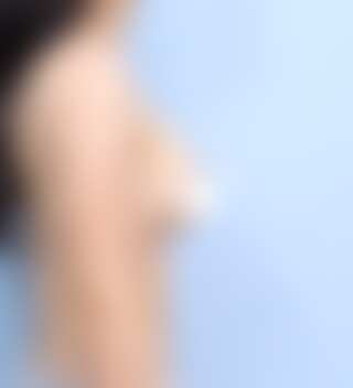 UNE 豊胸手術 術後 1ヶ月 メンター エクストラ 330cc 普通 30代 側面 症例 #34