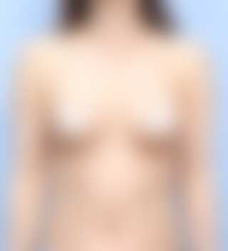 UNE 豊胸手術 術後 3ヶ月 モティバ 285cc 普通 50代以上 正面 症例 #35
