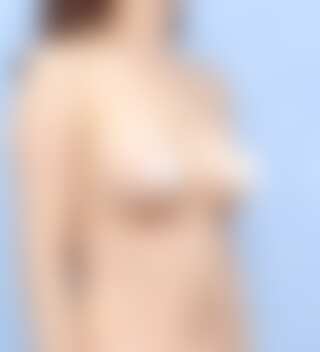 UNE 豊胸手術 術後 3ヶ月 モティバ 285cc 普通 50代以上 45度 症例 #35