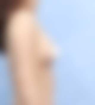 UNE 豊胸手術 術後 3ヶ月 モティバ 285cc 普通 50代以上 側面 症例 #35