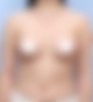 UNE 豊胸手術 術後 3ヶ月 モティバ 320cc ぽっちゃり 20代 正面 症例 #38