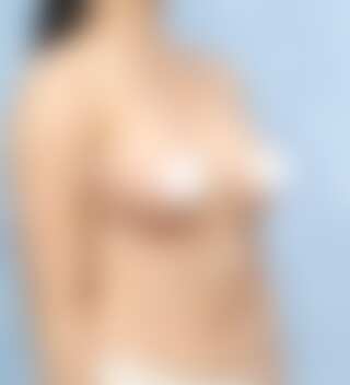 UNE 豊胸手術 術後 3ヶ月 モティバ 320cc ぽっちゃり 20代 45度 症例 #38