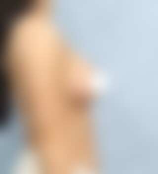 UNE 豊胸手術 術後 3ヶ月 モティバ 320cc ぽっちゃり 20代 側面 症例 #38