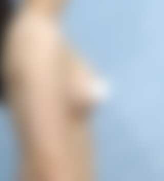 UNE 豊胸手術 術後 3ヶ月 モティバ 285cc 普通 30代 側面 症例 #39