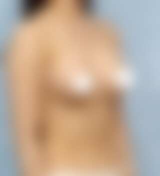 UNE 豊胸手術 術後 3ヶ月 モティバ 340cc 痩せ 20代 45度 症例 #41