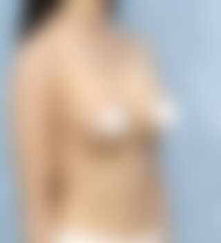 UNE 豊胸手術 術後 3ヶ月 モティバ 320cc 痩せ 30代 45度 症例 #42