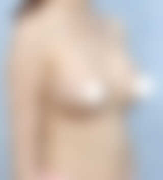 UNE美容外科 - 豊胸 | 術後 3ヶ月 · 45度 · 普通体型 · 30代 · メンター ブースト · 腋窩切開 · 症例 #28