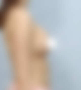 UNE美容外科 - 豊胸 | 術後 3ヶ月 · 側面 · 普通体型 · 30代 · メンター ブースト · 腋窩切開 · 症例 #28