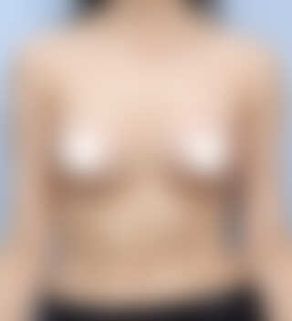 UNE 豊胸手術 術後 3ヶ月 モティバ 340cc 普通 30代 正面 症例 #54