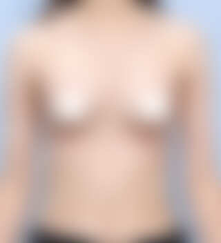 UNE 豊胸手術 術後 1ヶ月 セビン 330cc 普通 30代 正面 症例 #55