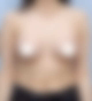 UNE 豊胸手術 術後 2ヶ月 モティバ 380cc ぽっちゃり 30代 正面 症例 #61