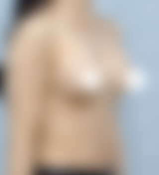 UNE Plastic Surgery - เสริมหน้าอก | After 2 mo · 45° · ปริมาตรไม่เพียงพอ · ปานกลาง body · 20s · Motiva · ใต้รักแร้ incision · Case #43