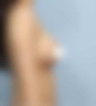 UNE バスト修正 術後 1ヶ月 モティバ 375cc 普通 30代 側面 症例 #72